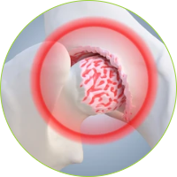 Knee Surgery - Osteoarthritis