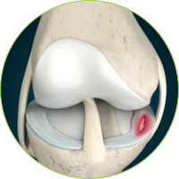Knee Surgery - Meniscal tears