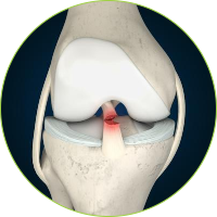 Knee Surgery - Ligament tears
