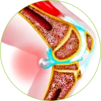 Knee Surgery - Baker's cyst