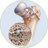 Knee Surgery - Osteonecrosise