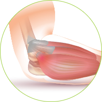 Knee Surgery - Tendinitis